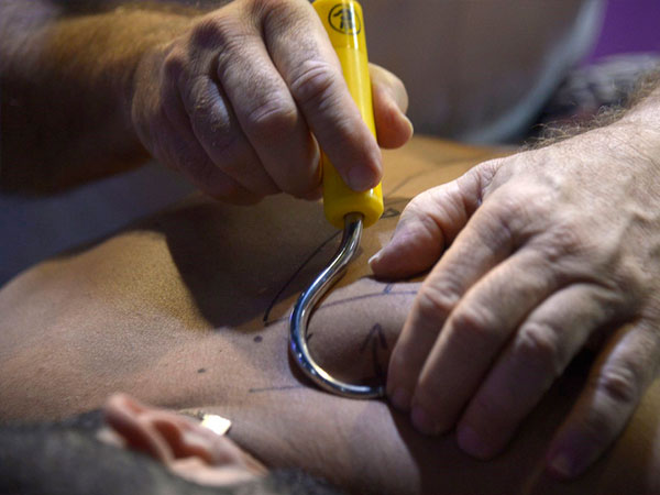 Efeito da Crochetagem na recuperação funcional de cicatrizes antigas limitantes